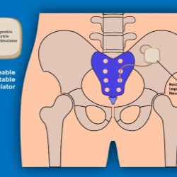U.S. FDA Approves Aptar’s  Proprietary Activ-Film Technology for use with Rechargeable Implantable Neurostimulator